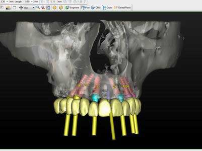 Имплантация зубов с навигатором
